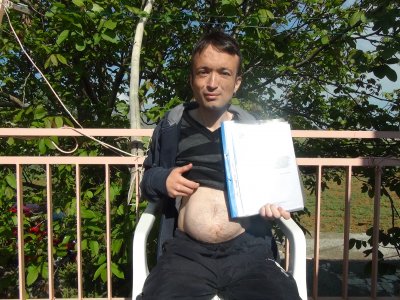 Vücudundaki 35 cm'lik tümör ile yaşayan hasta tedavi bekliyor
